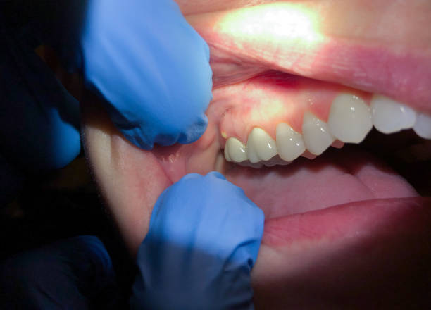 Best Cracked Tooth Emergency Dentist  in Hillsborough, NC